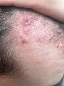 Pojava akni nakon transplantacije kose Akne nakon transplantacije kose