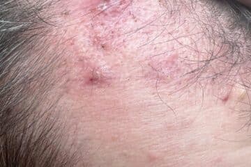 Pojava akni nakon transplantacije kose