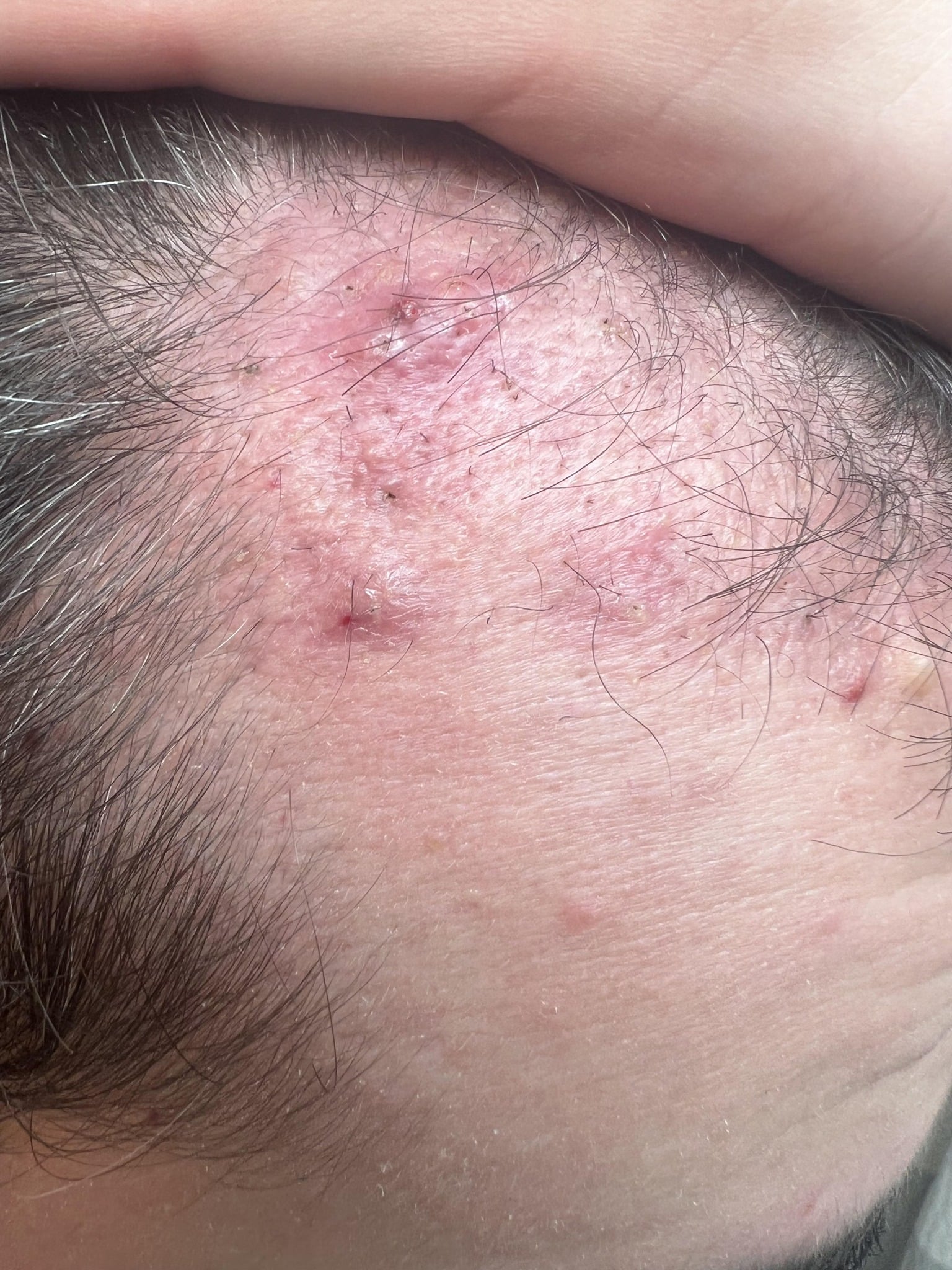 Pojava akni nakon transplantacije kose