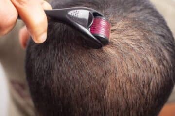 Dermaroler nakon transplantacije kose