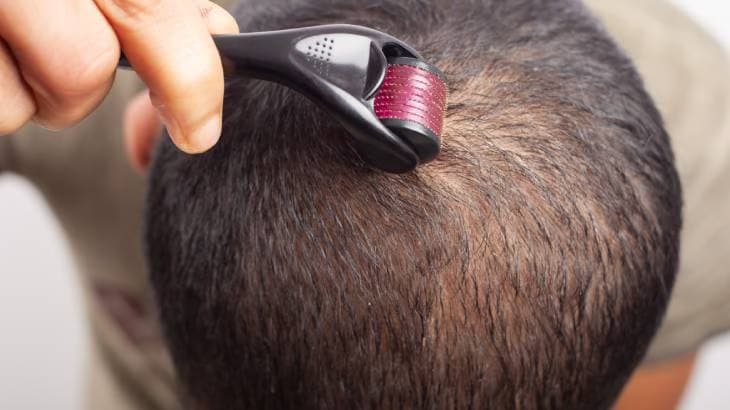 Dermaroler nakon transplantacije kose Dermaroler nakon transplantacije kose